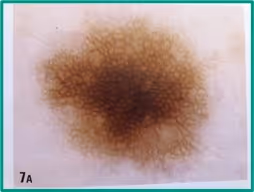 Padrão dermatoscópico retículo-homogêneo