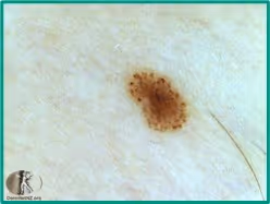 Padrão dermatoscópico globular