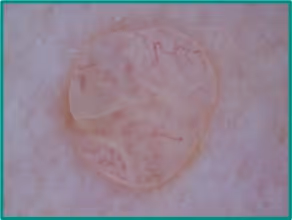 Padrão dermatoscópico homogêneo