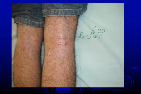 Dermatite atópica em adolescente agravada pelo ressecamento excessivo durante o inverno