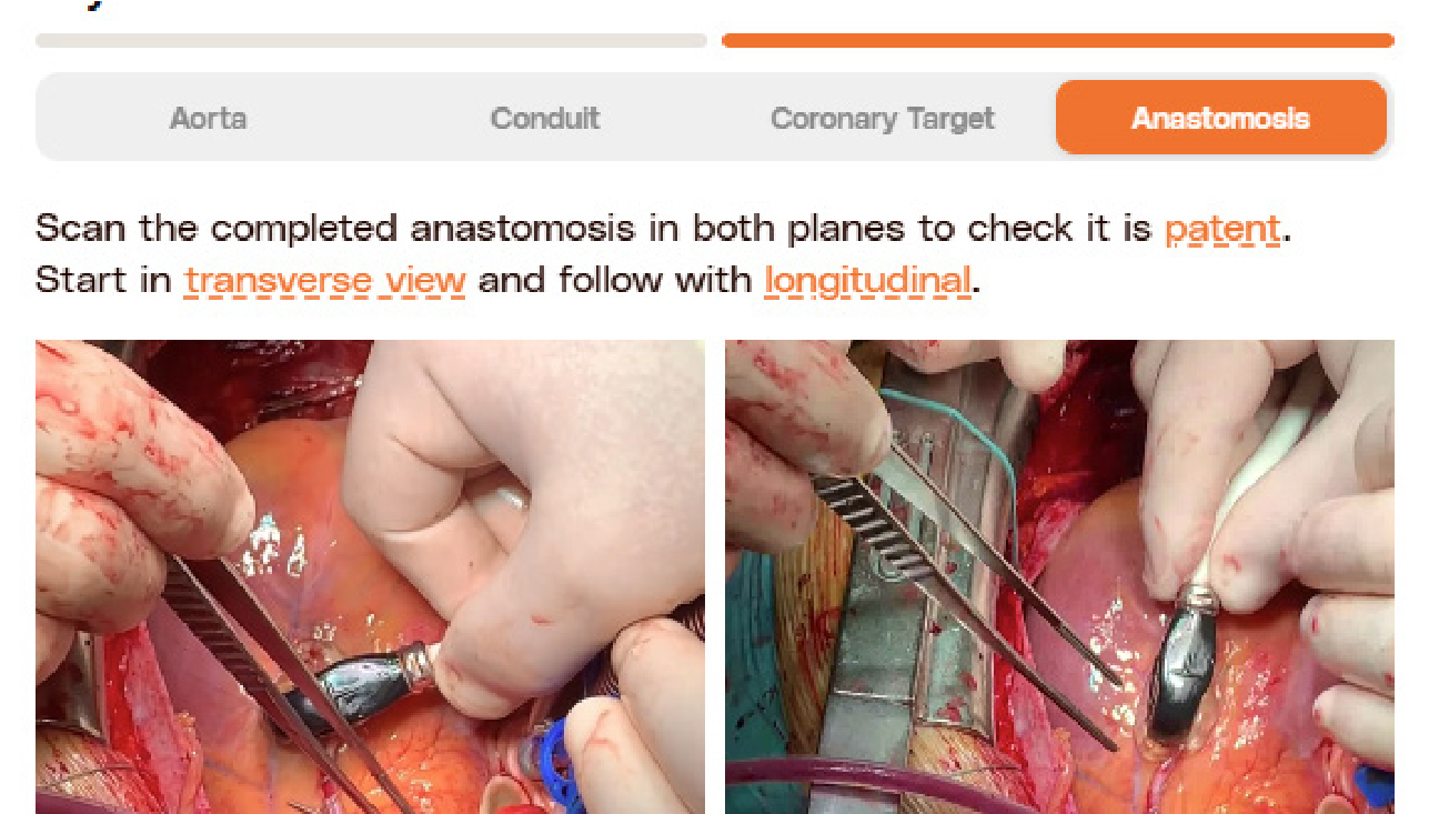 Two close-up photos showing hands in surgical gloves performing coronary anastomosis on an exposed heart during surgery using fine surgical instruments.
