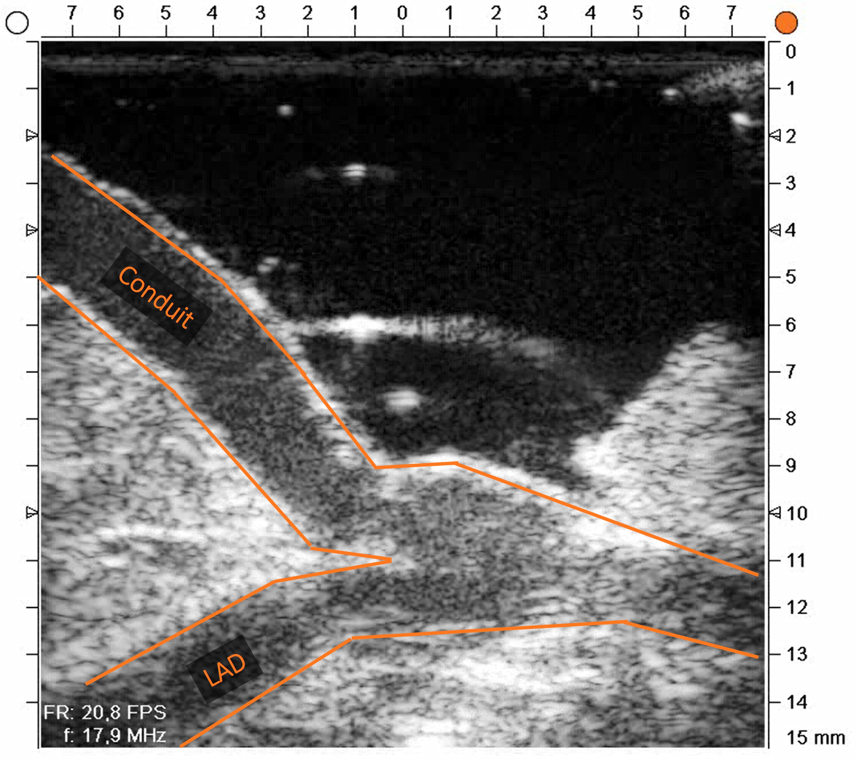 Conduit and LAD during CABG