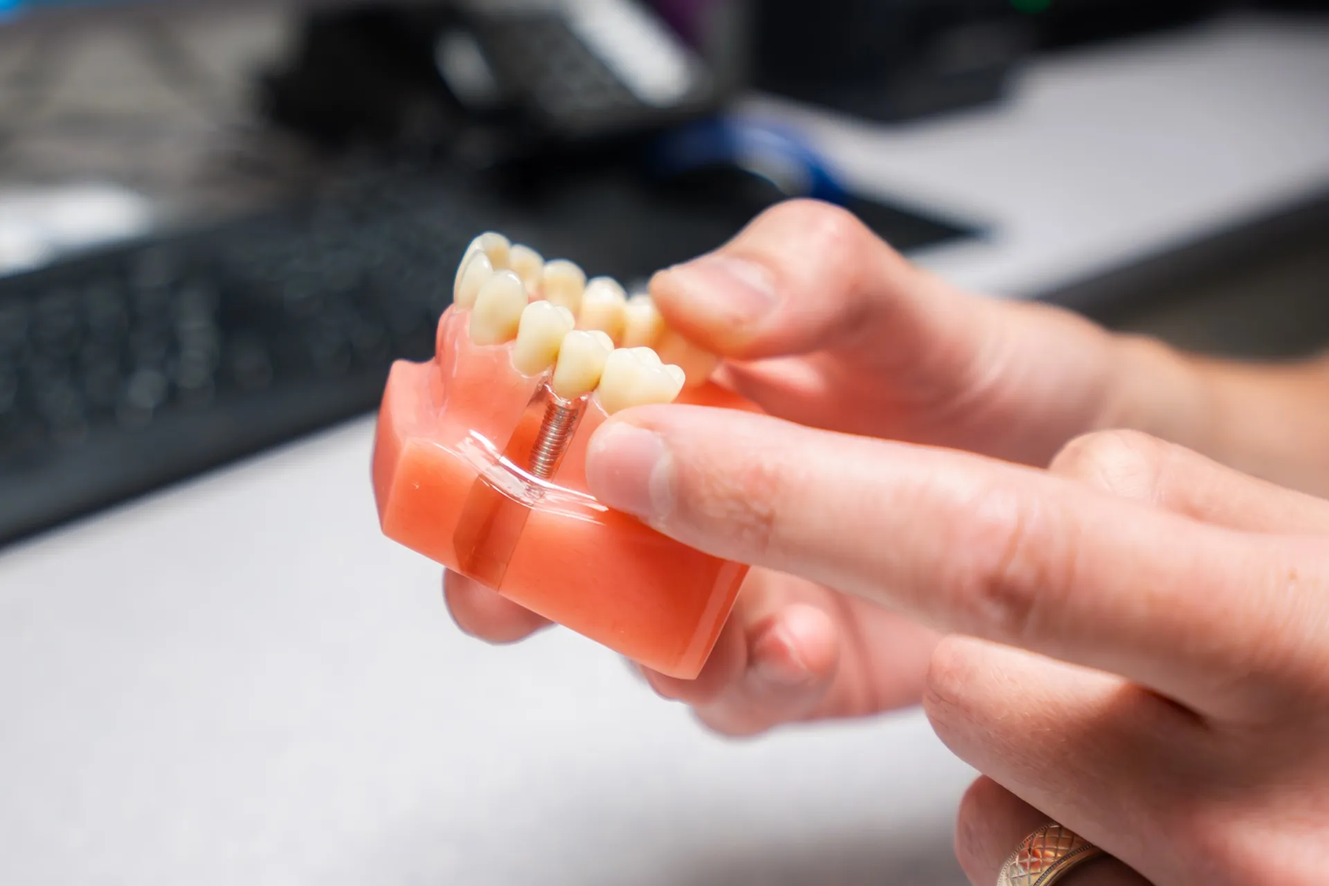 dental implants