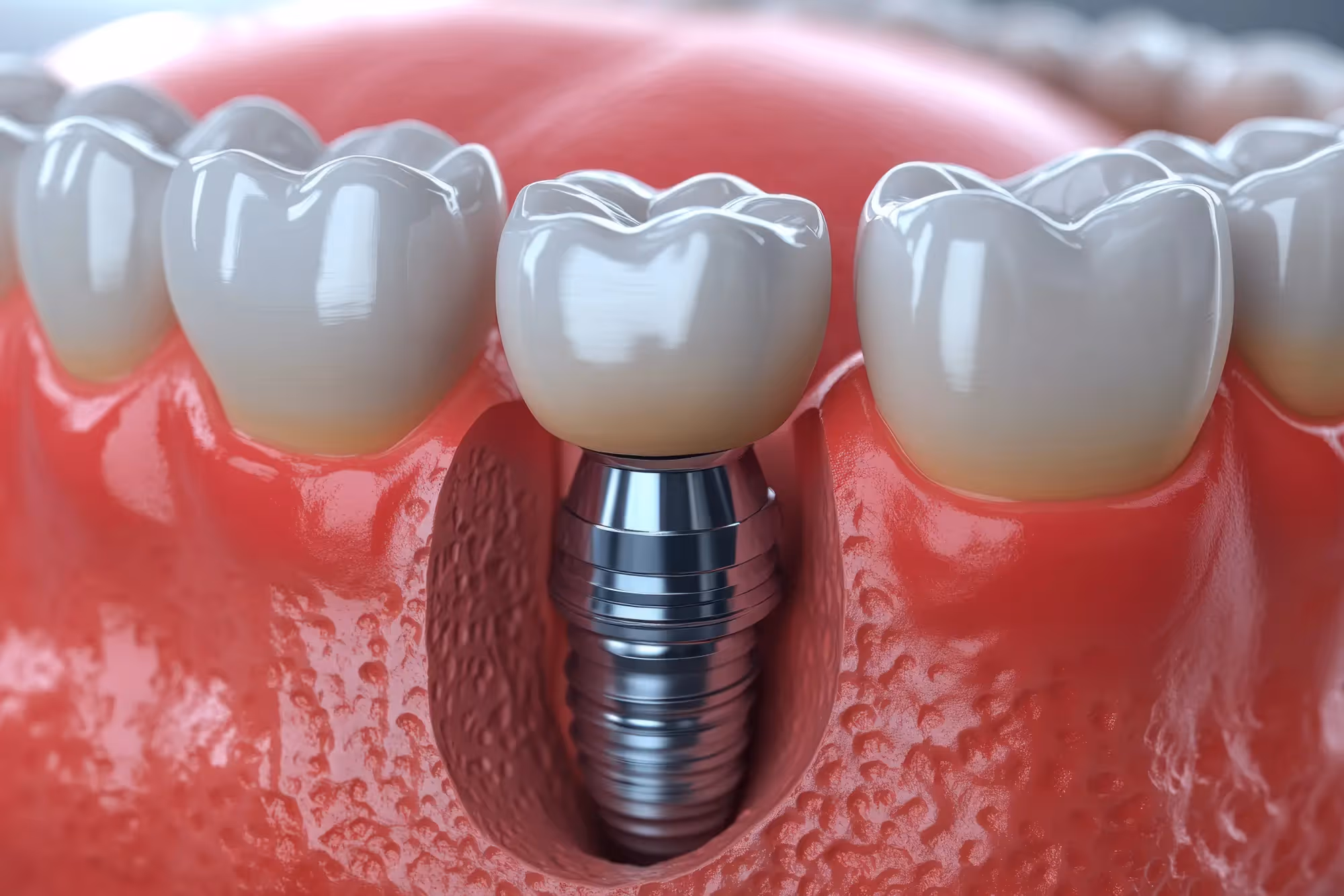 How to Care for Your Dental Implants Long-Term