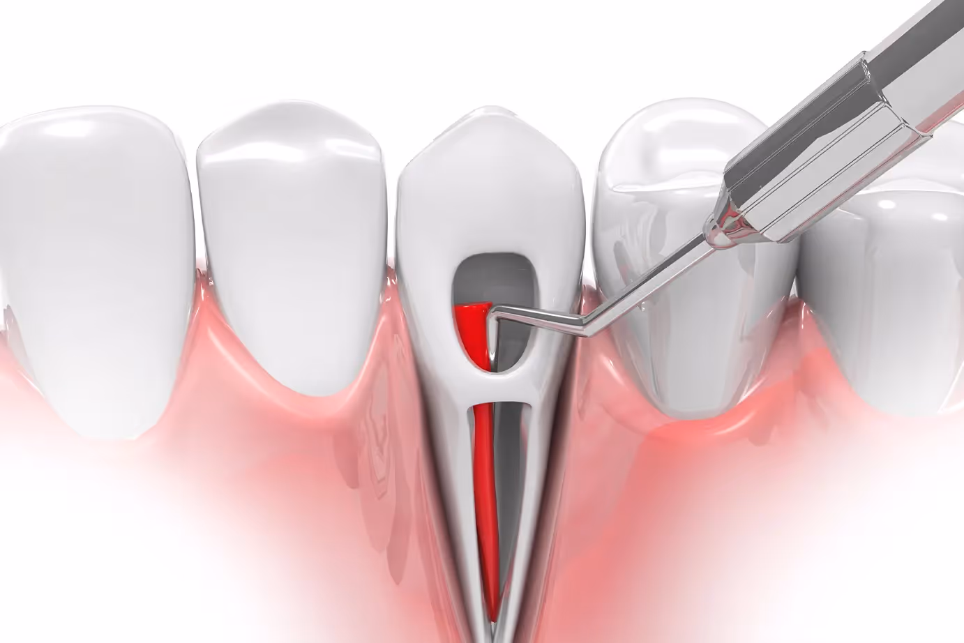 Can a Root Canal Get Infected?