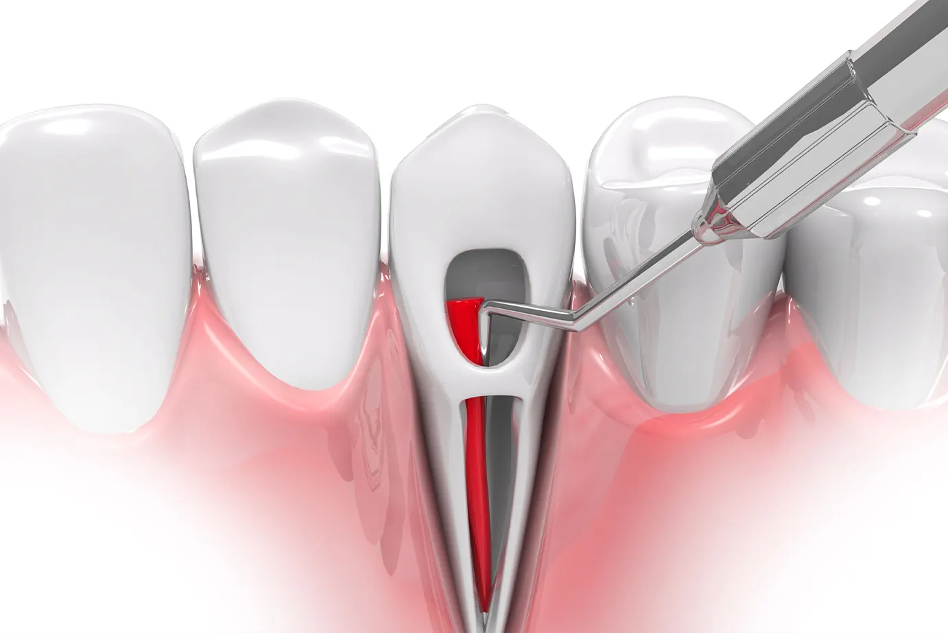 Can a Root Canal Get Infected?