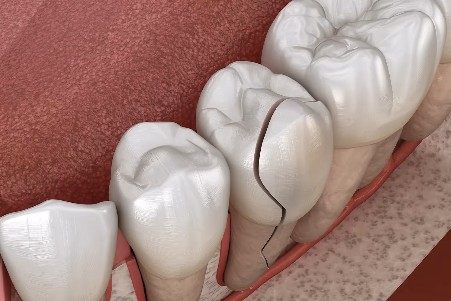 Emergency Dentist Tips: What to Do While Heading to Our San Diego Office