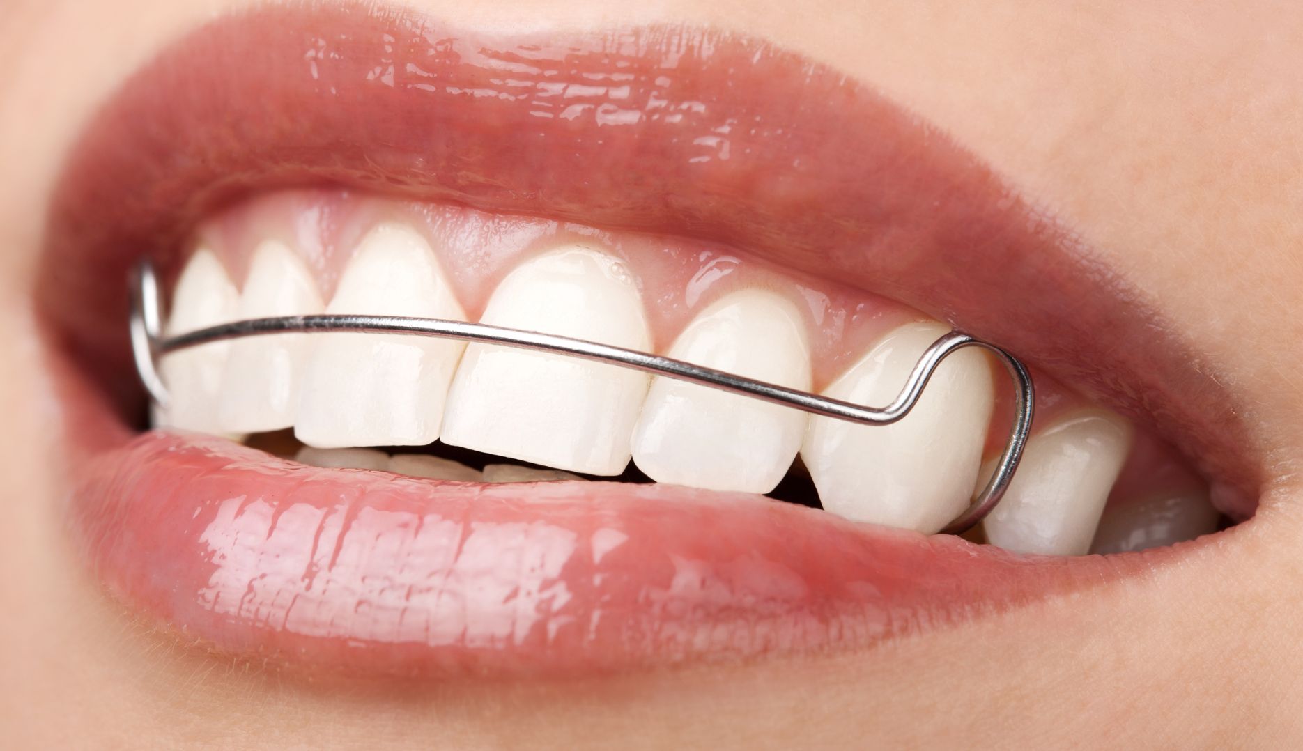 What are Hawley Retainers?