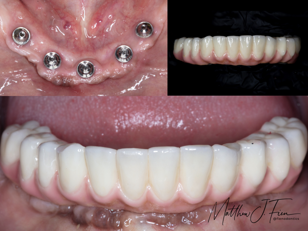 All-on-4 case view 1