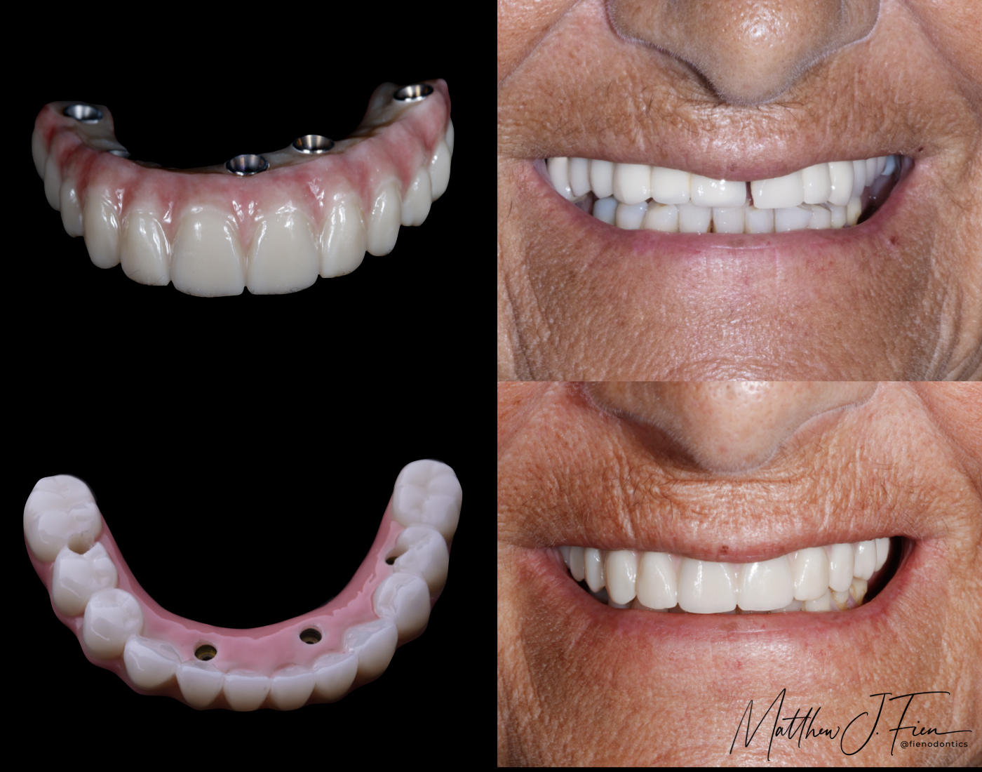 All-on-4 case view 4