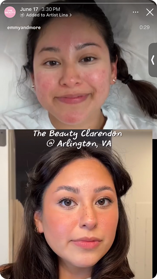 Before and after facial treatment comparison of a woman's skin with reduced redness and clearer complexion.