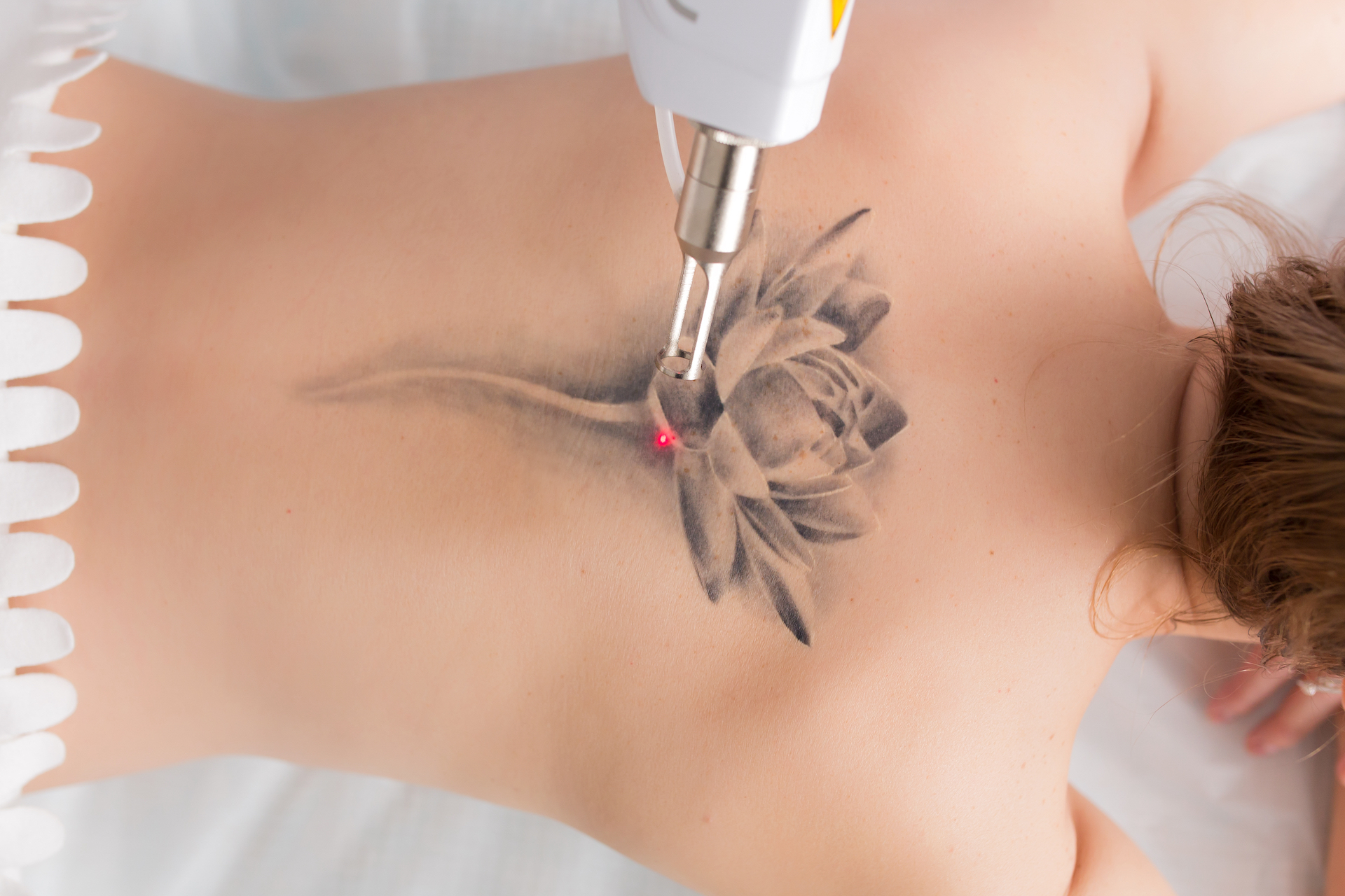 Laser Tattoo Removal | Cosmetic Dermatology | Premier Dermatology and Cosmetic Surgery