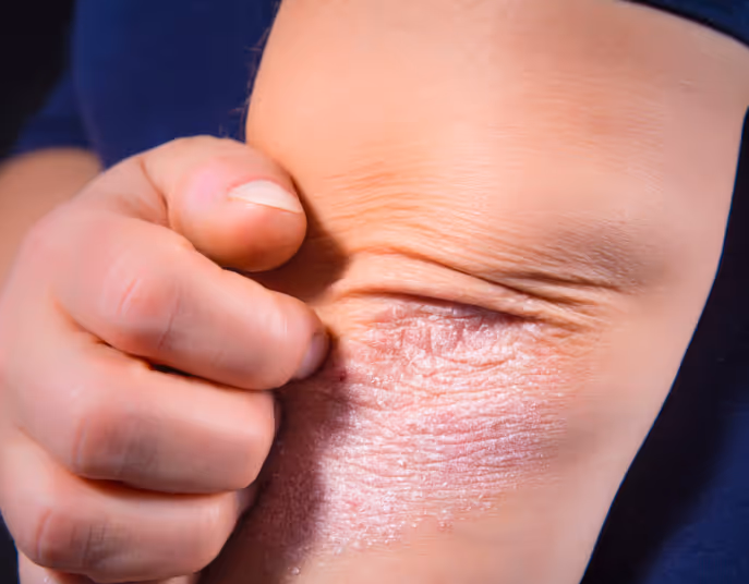 Un'immagine di un paziente affetto da psoriasi che si pizzica il gomito dove è presente una chiazza di psoriasi.