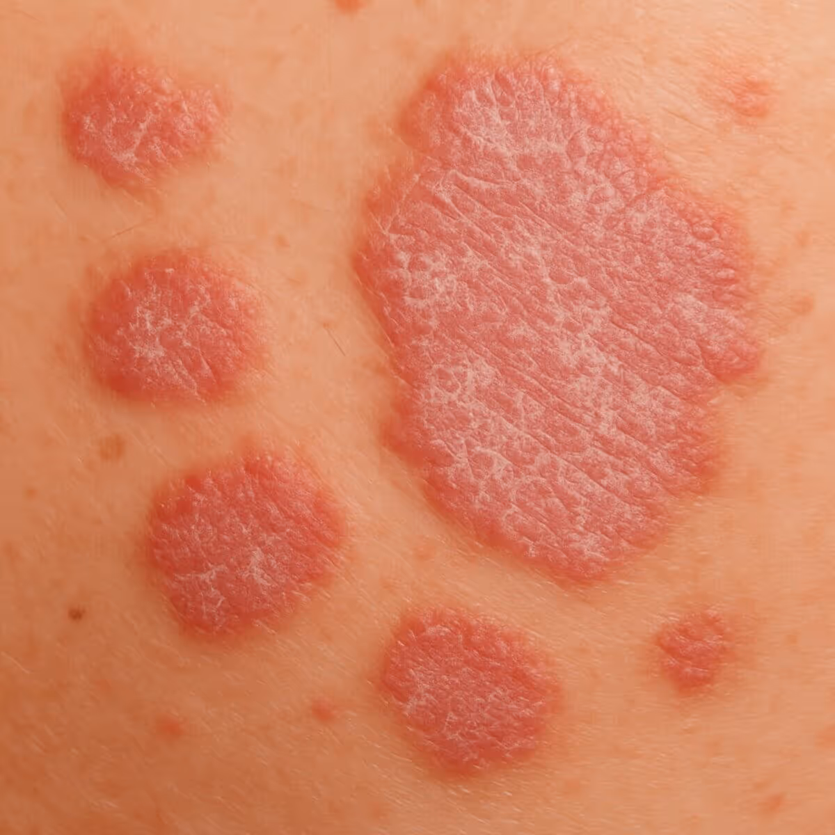 Un'immagine di una grande chiazza di psoriasi con chiazze più piccole intorno ad essa