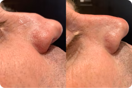 Crow's feet before and after