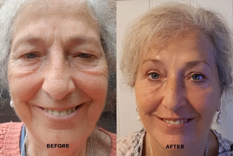Crow's feet before and after