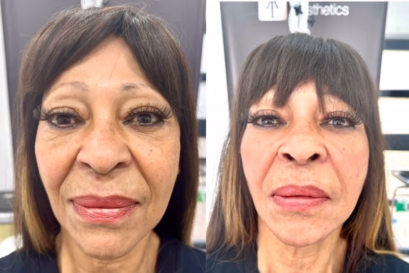 Before and after non-surgical facelift – improved contour and facial support