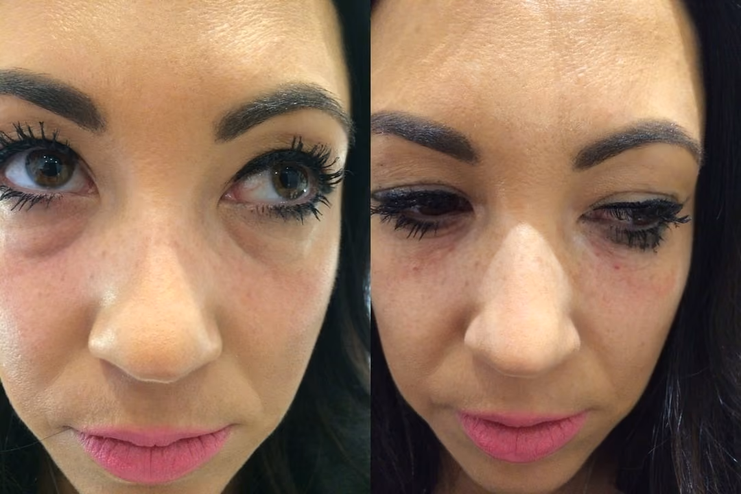 tear trough filler London
