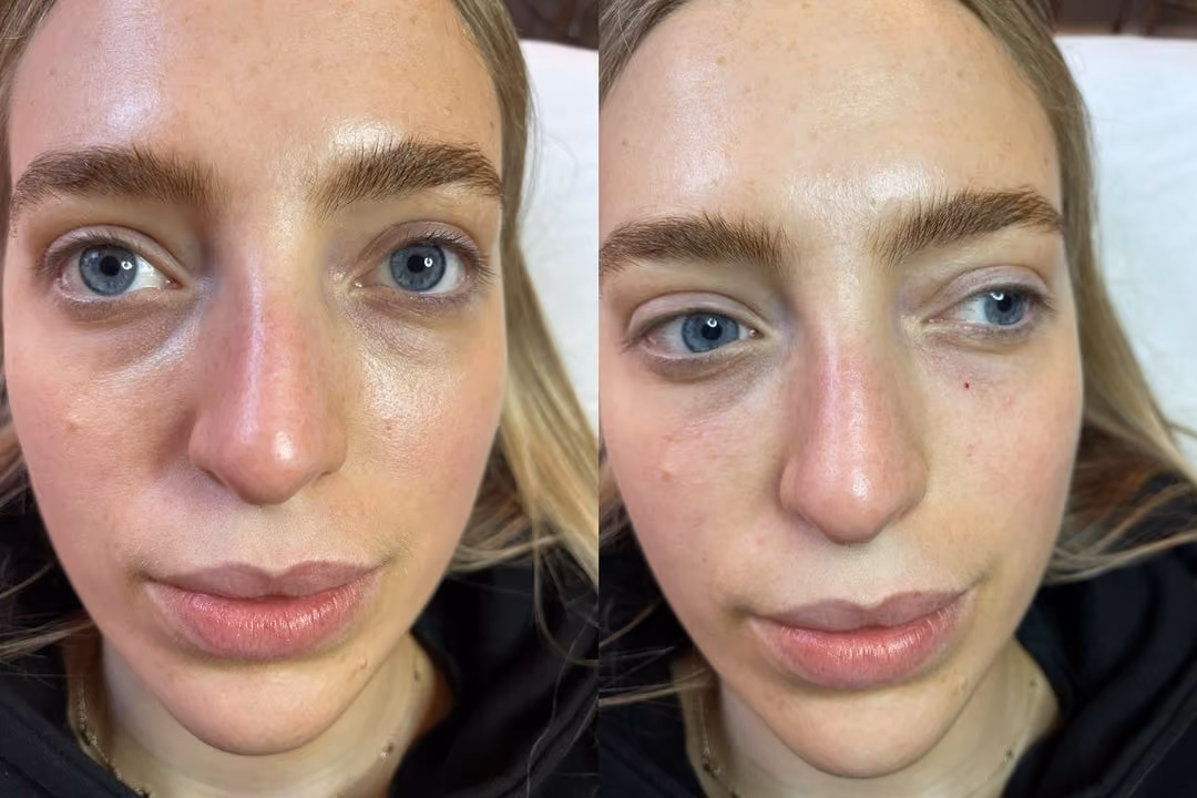 tear trough filler injections London