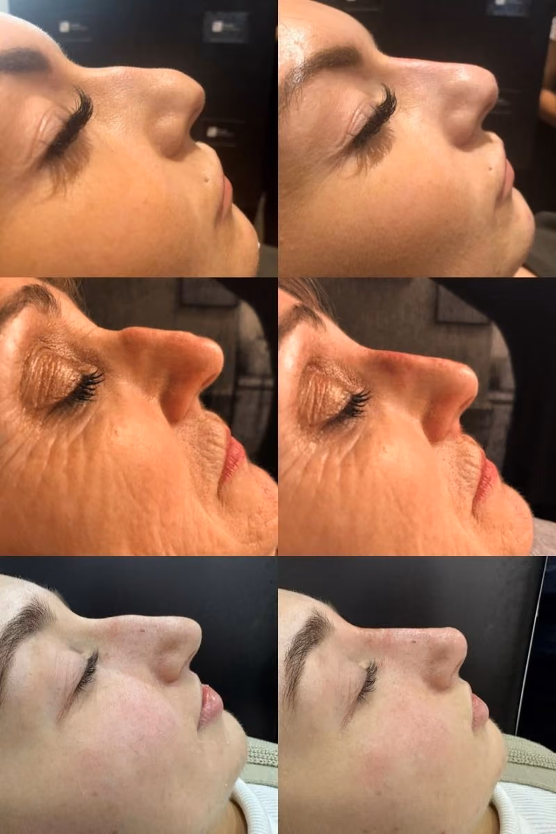Non-surgical rhinoplasty wolverhampton