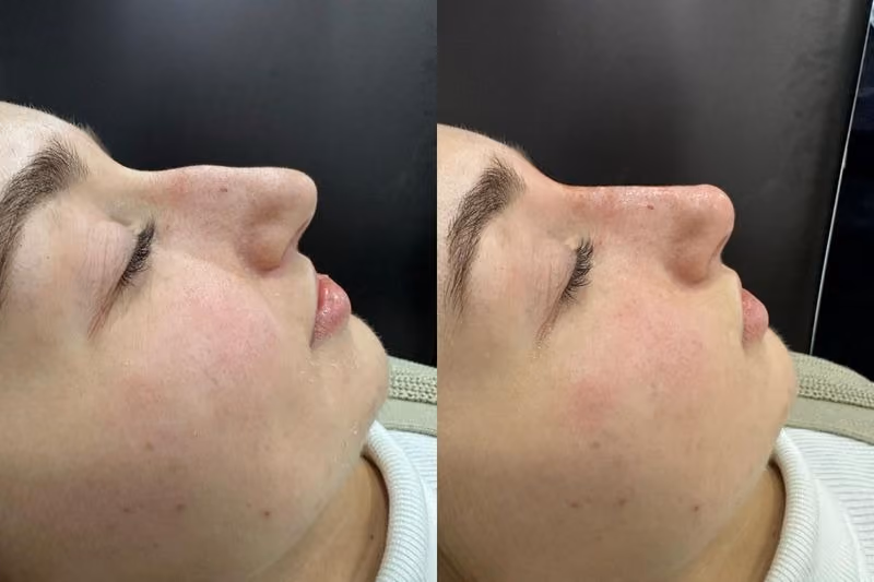 Crow's feet before and after