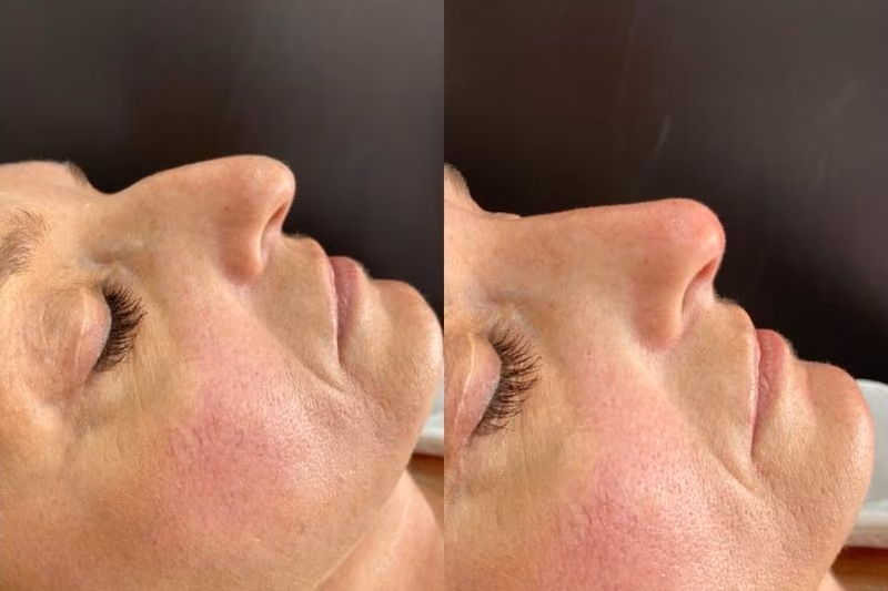 Crow's feet before and after