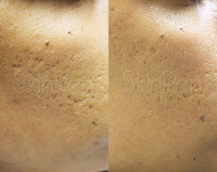 Before and After Treatment