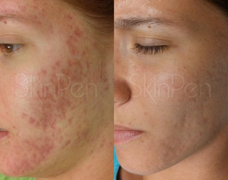 Before and After Treatment