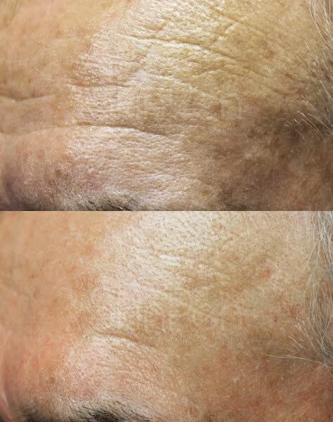 Before and After Treatment