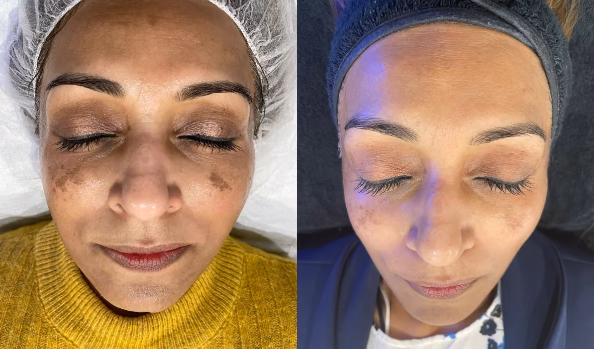 Crow's feet before and after