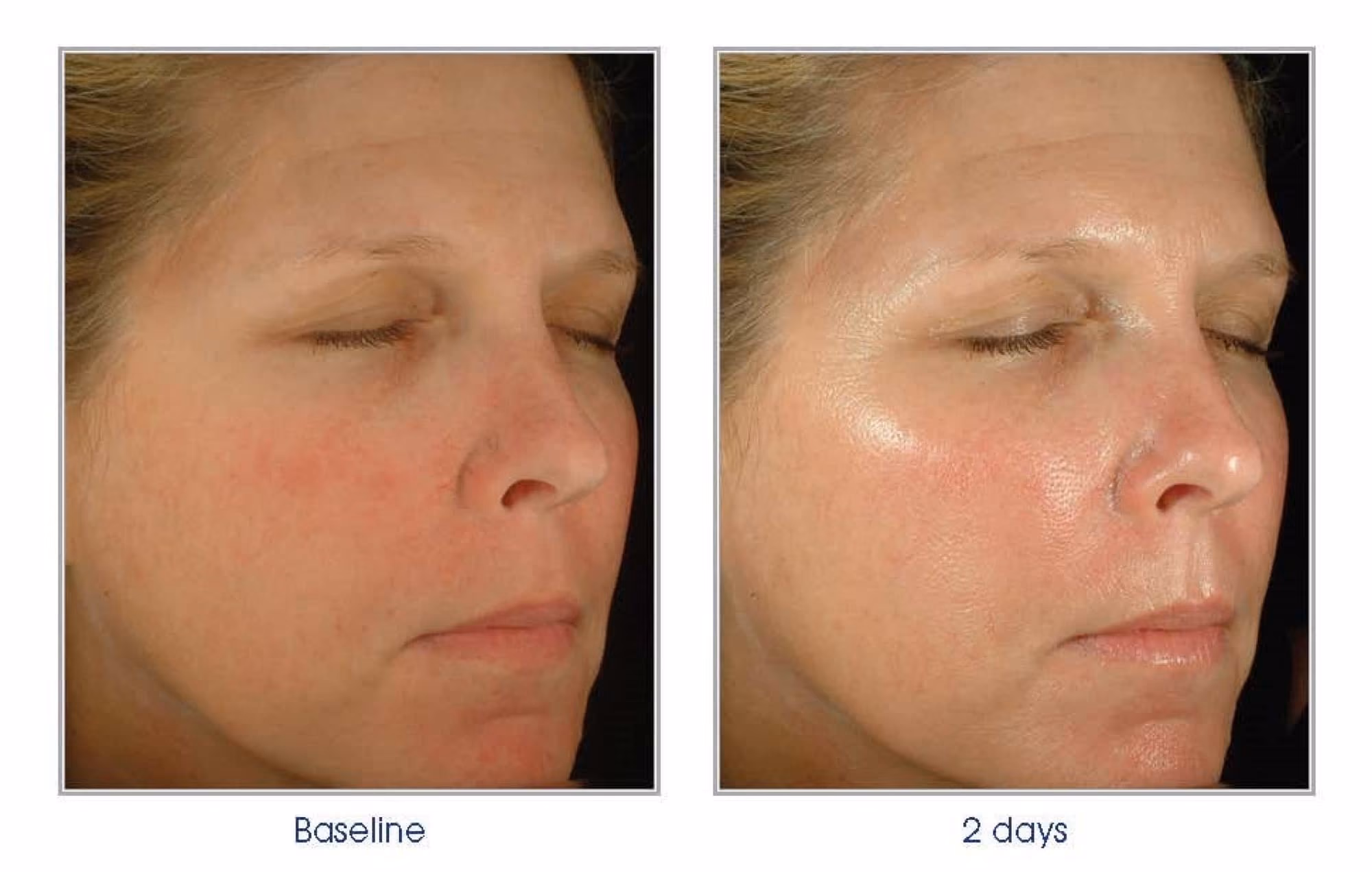 Obagi blue peel radiance results