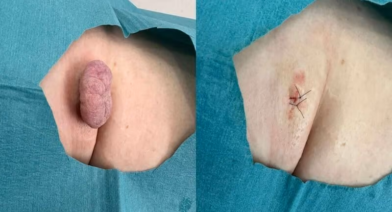 mole before after