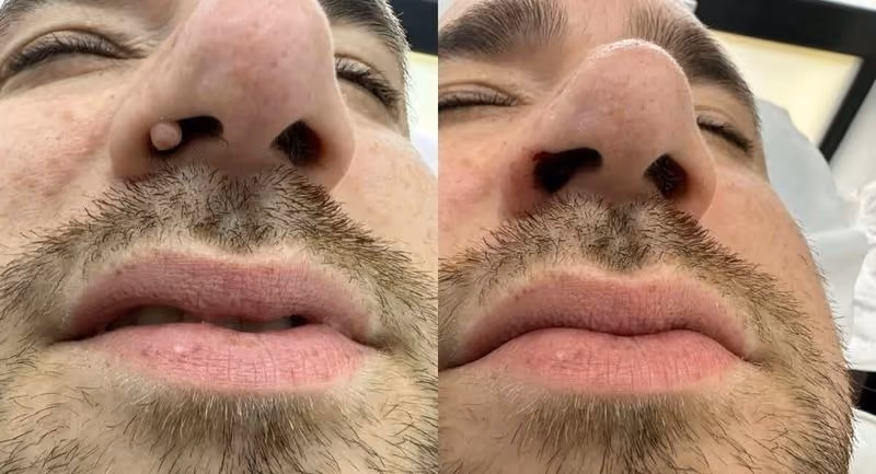 mole before after