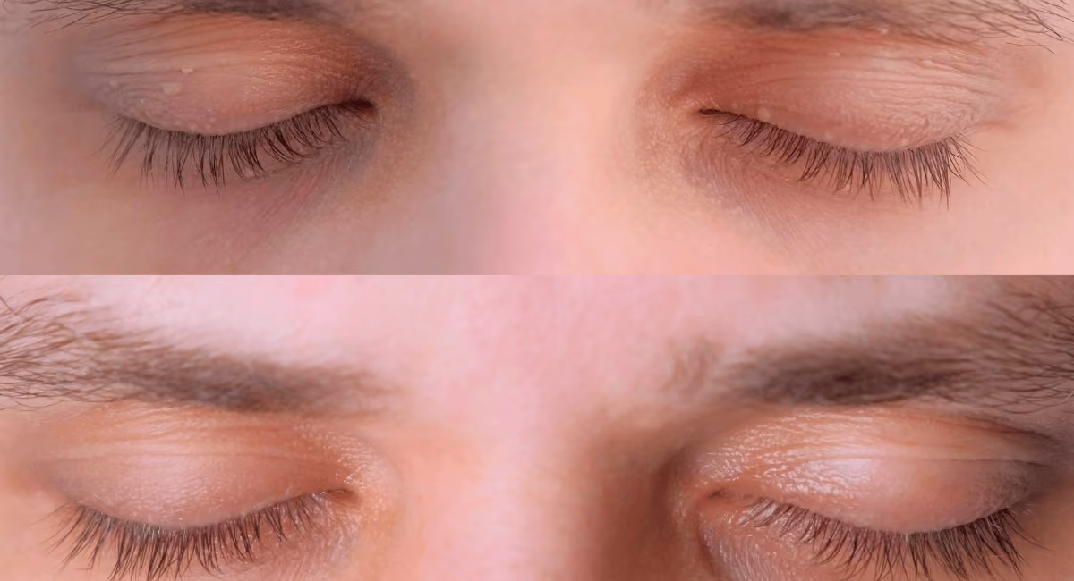 Minor Ops Before After results