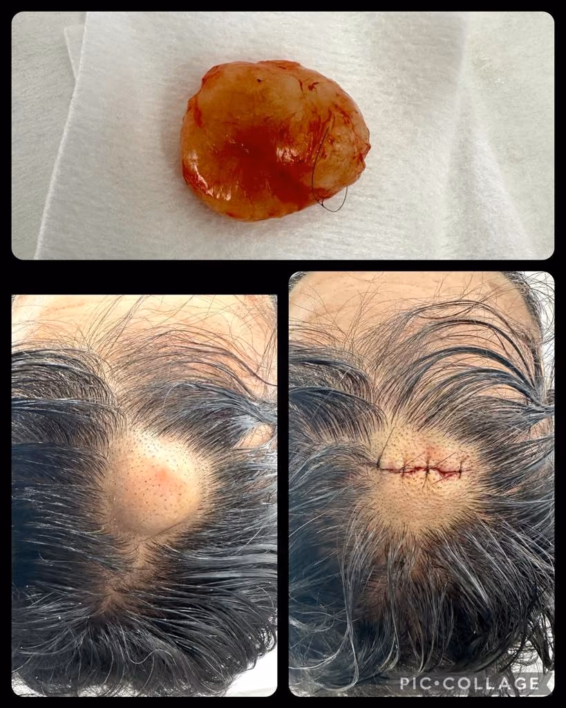 mole before after