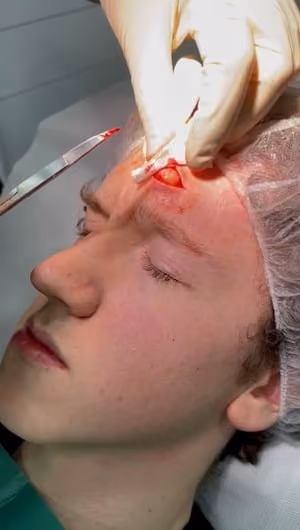 Cyst removal video thumbnail