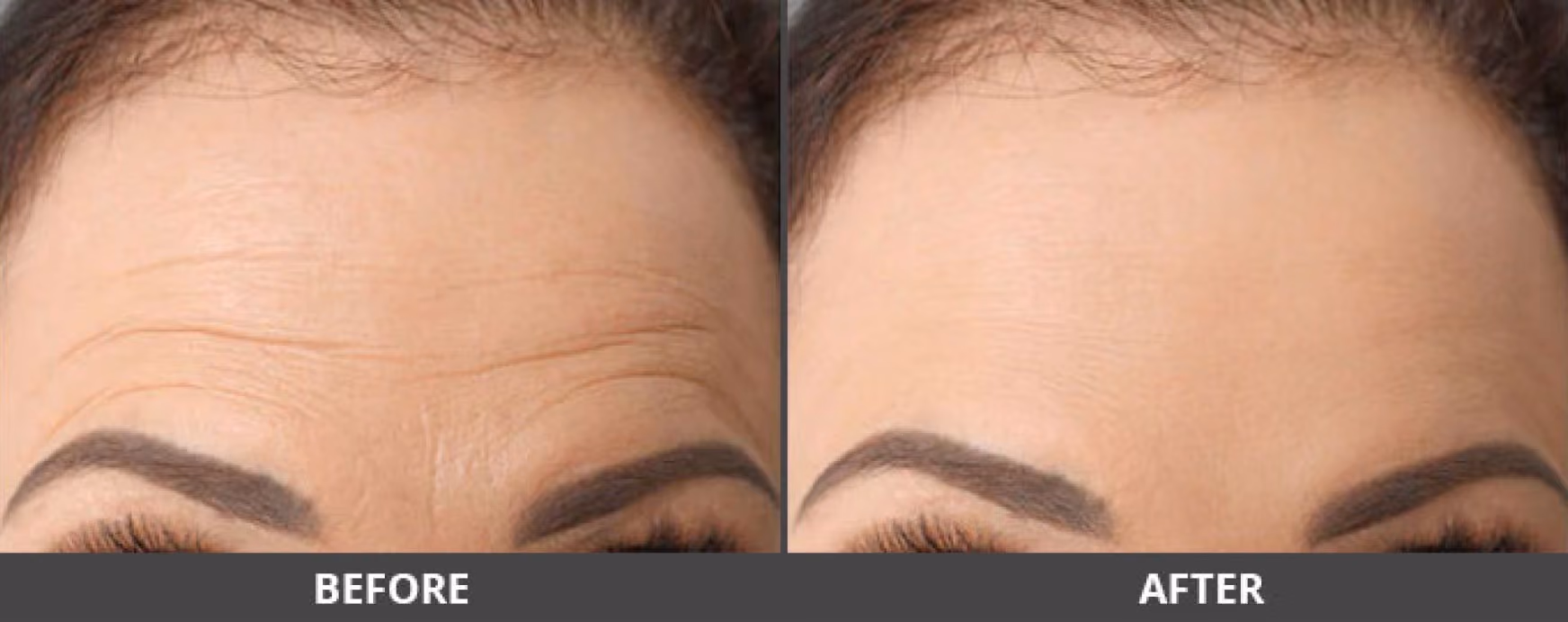 Forehead lines before and after