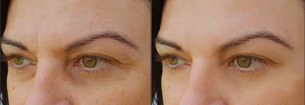 Dark circles before and after