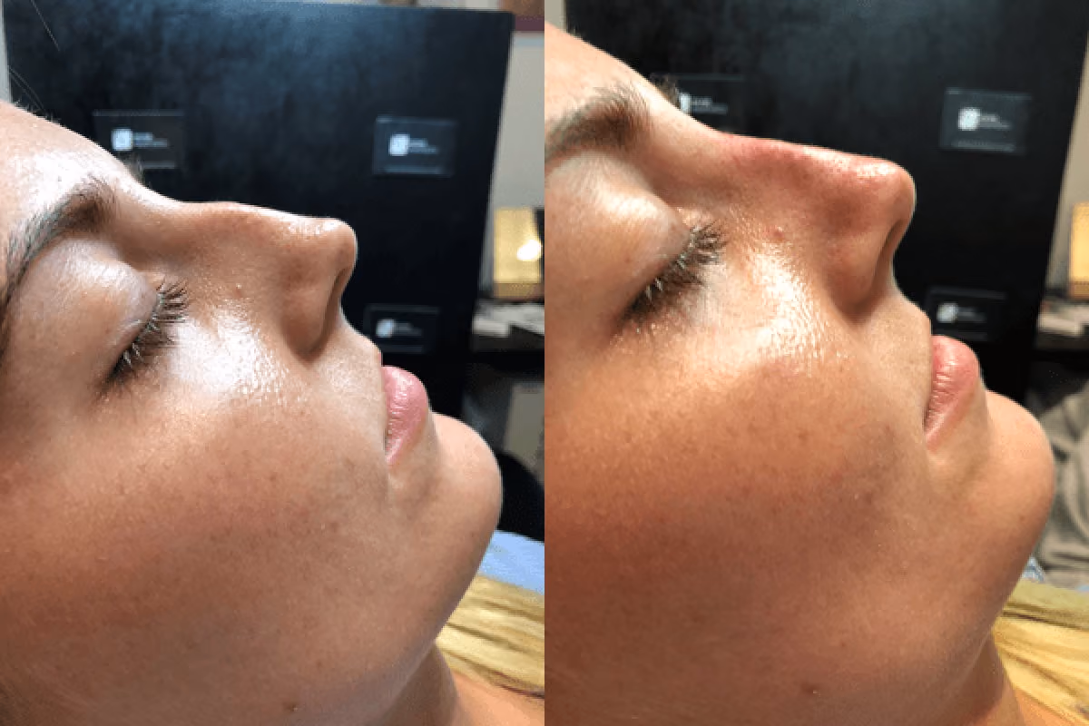 Before and after nose filler Solihull — side profile improvement