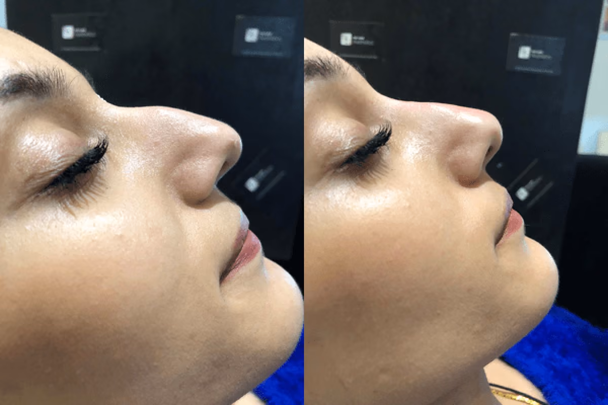 Non-surgical nose job before and after