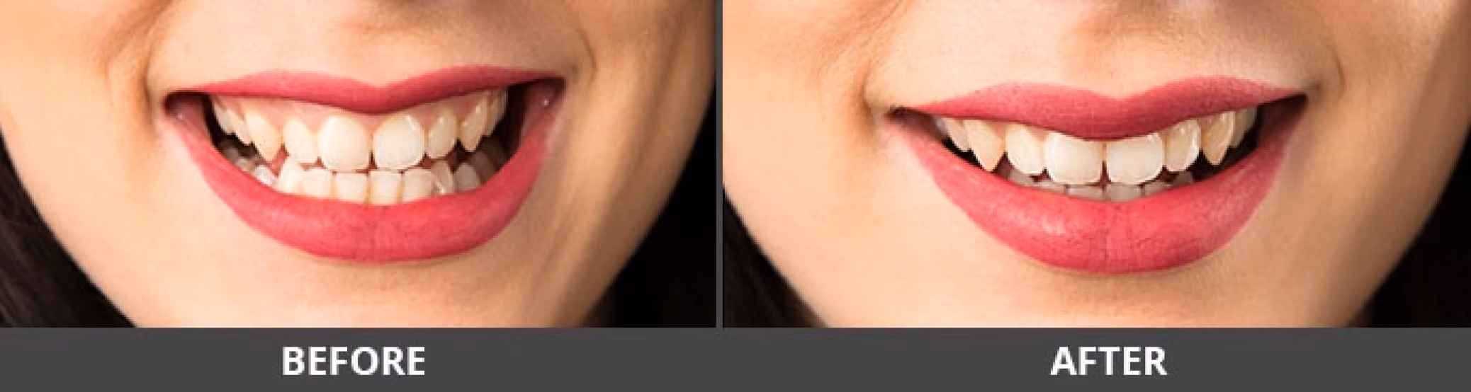 Gummy smile treatment results