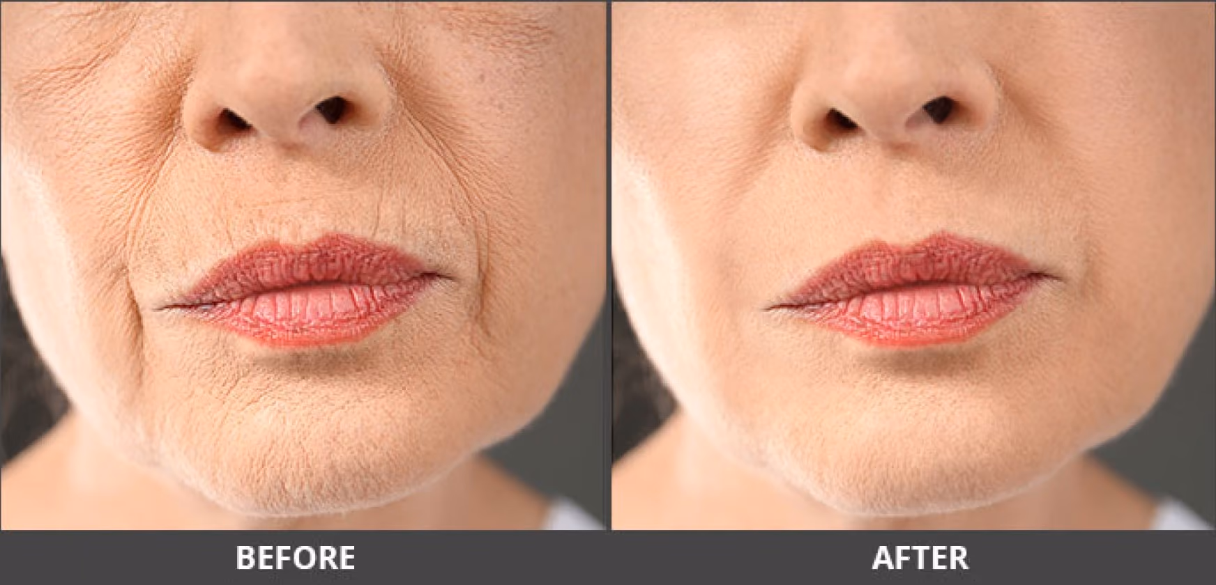 Chin enhancement result