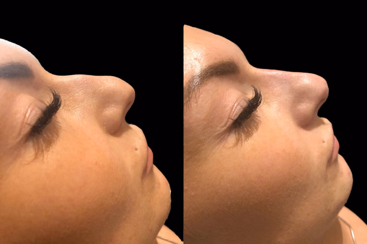 Before and after nose filler Solihull — side profile improvement