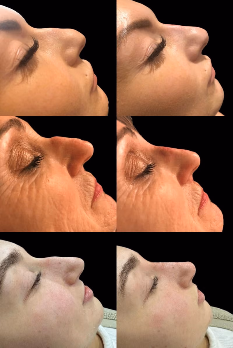 Non-Surgical Rhinoplasty