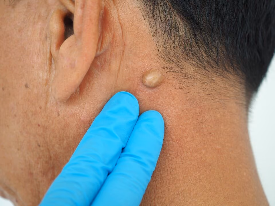 Cyst Removal Birmingham