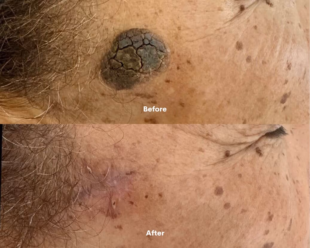 Minor Ops Before After results