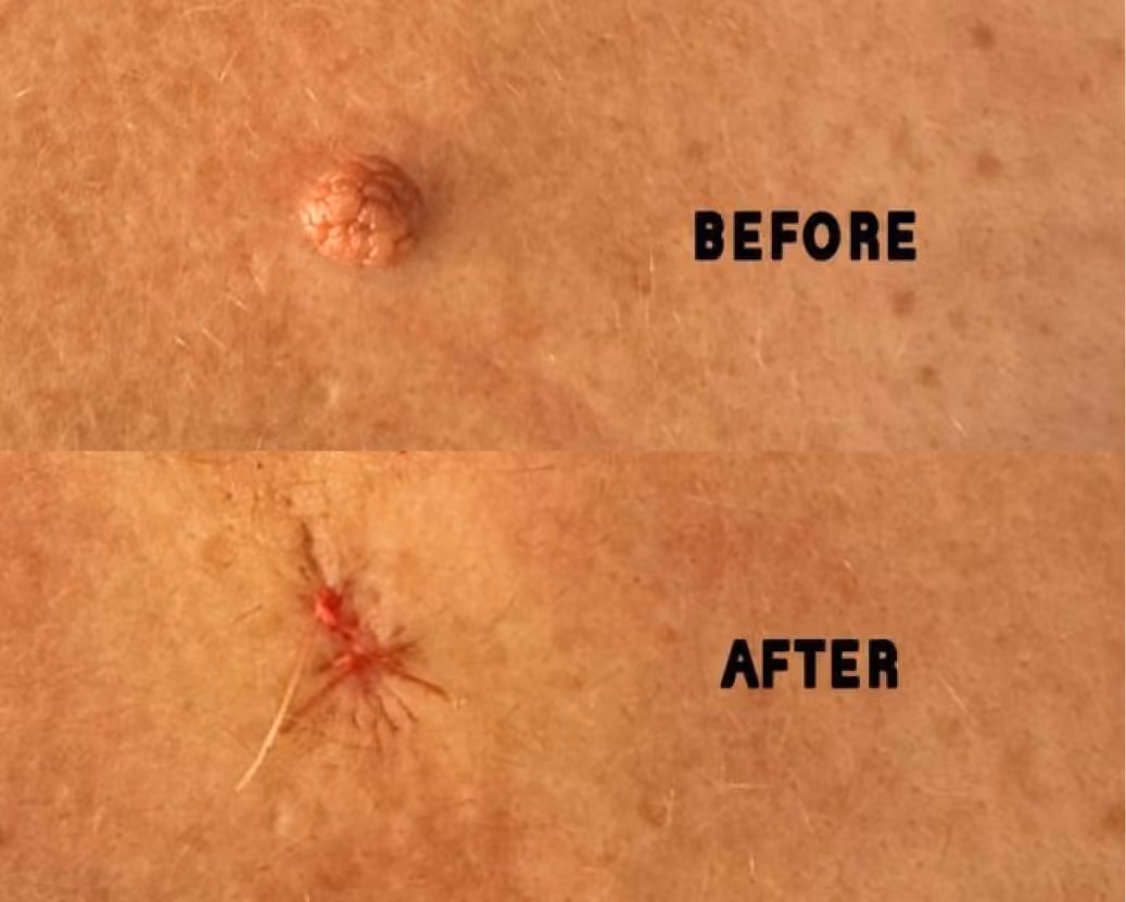 cyst/mole removal