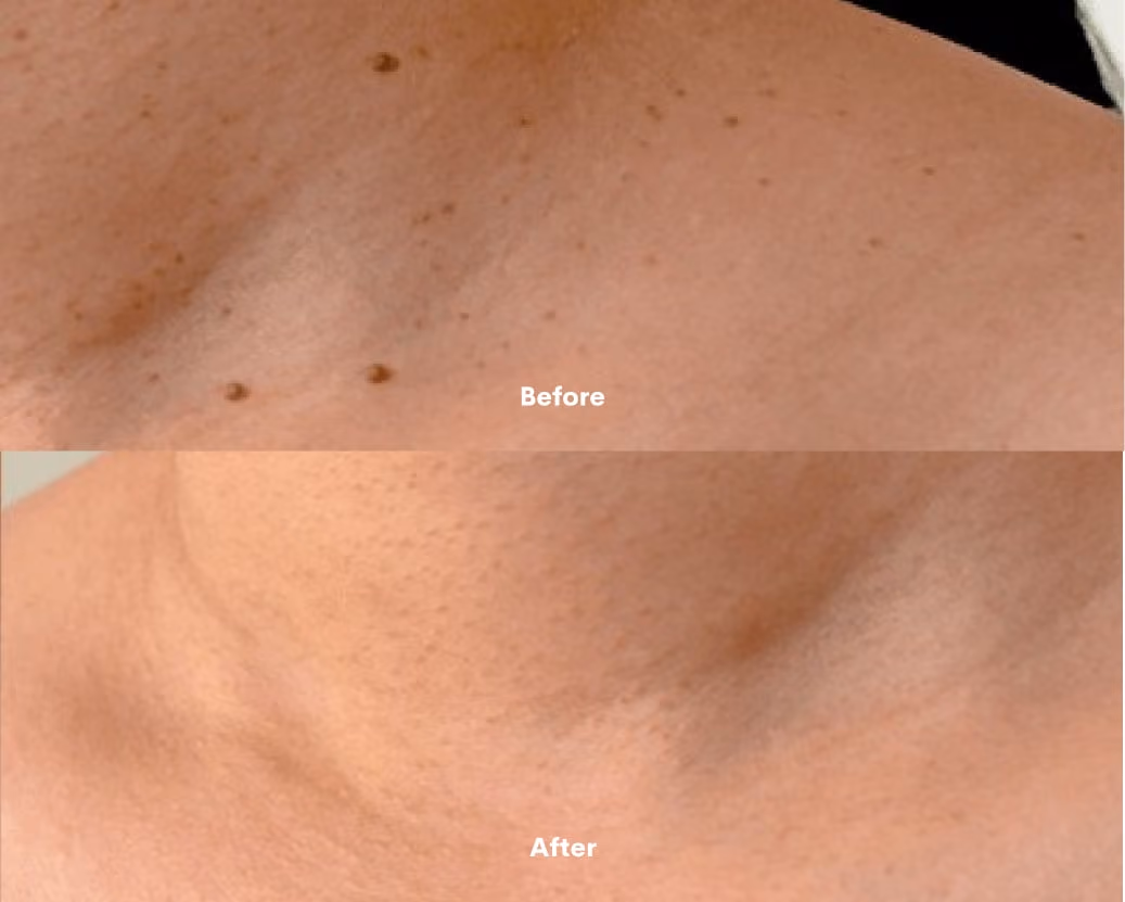 Minor Ops Before After results