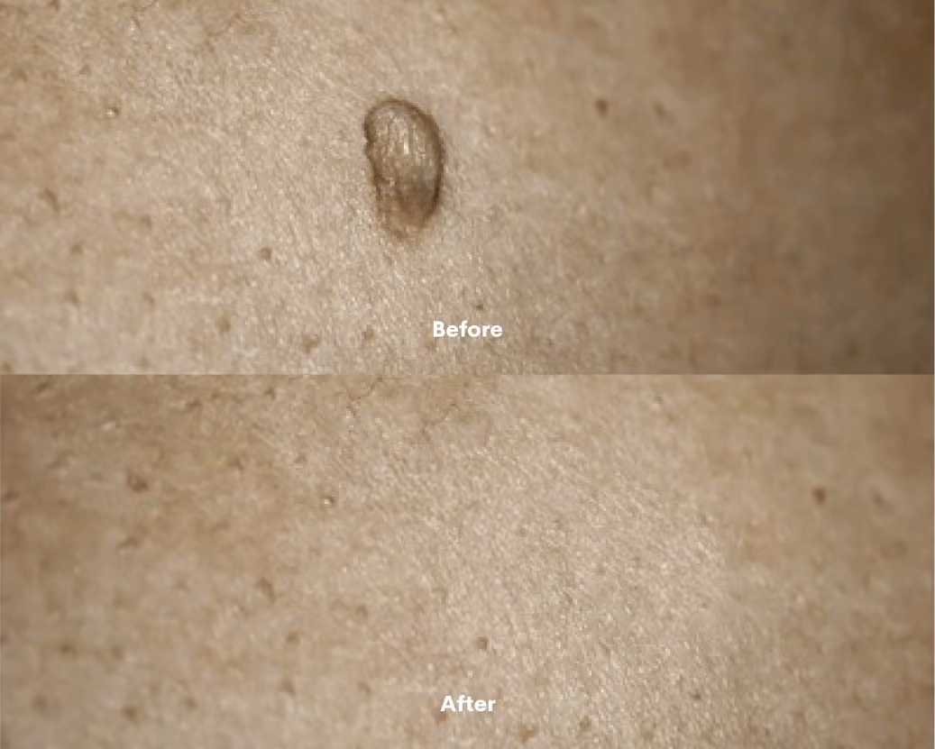 Minor Ops Before After results