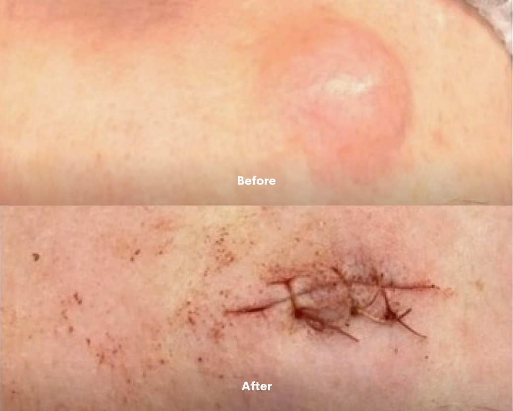 Cyst Removal before after